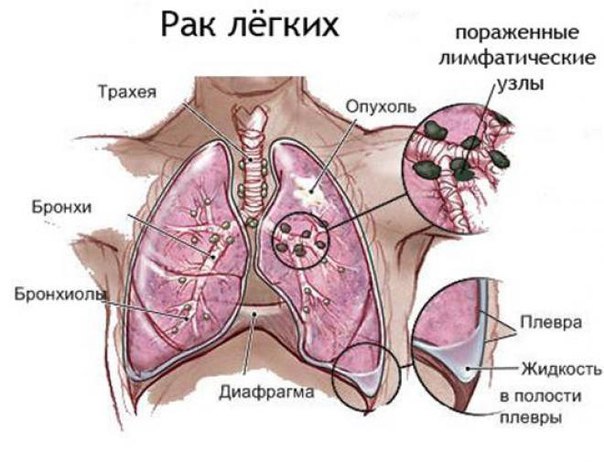 Реальный случай победы человека над раком легкого Реальный случай победы человека над раком легкого