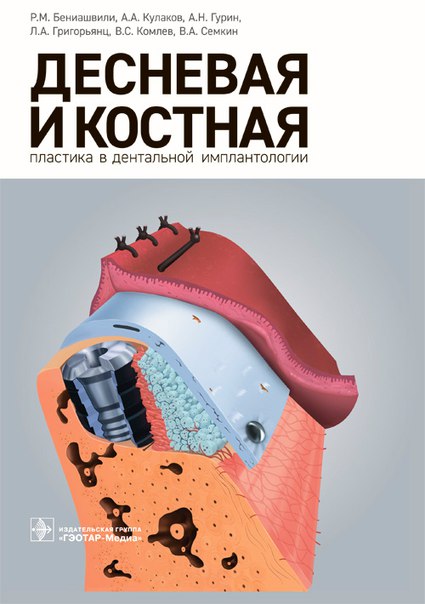 Десневая и костная пластика в дентальной имплантологии! 2017 год!