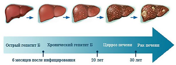 Заболевания печени