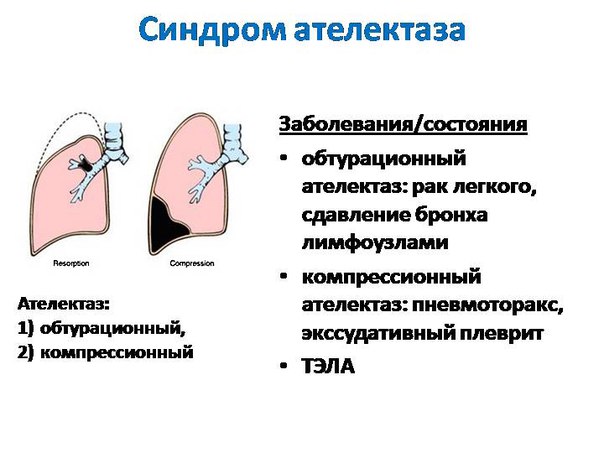 Ателектаз (уплотнение легочной ткани невоспалительной природы) - это спадение легкого или его части, наблюдаемое при прекращении доступа воздуха в альвеолы. 