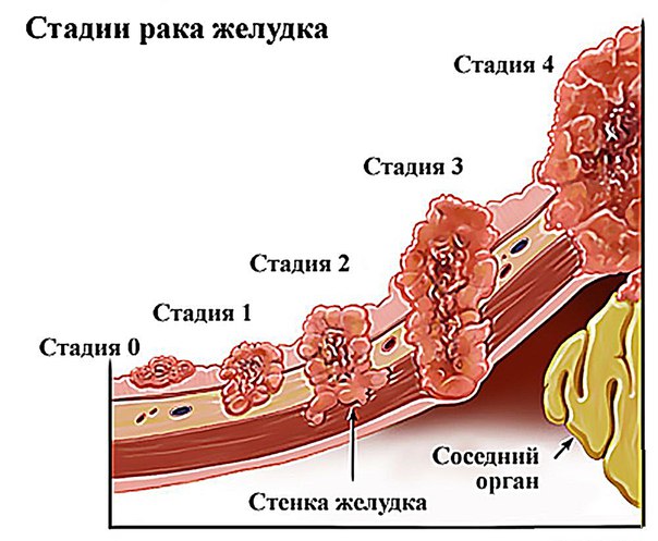 Метастазы рака желудка. 