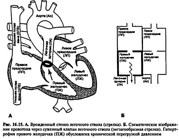 Стеноз легочного ствола (изолированное сужение легочной артерии) 