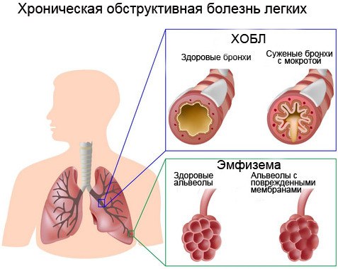 Хроническая обструктивная болезнь легких — ХОБЛ 