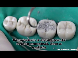 How to restore tooth decay #Tooth #Thedoctorchannel