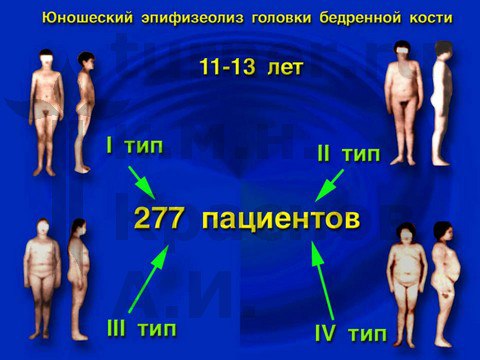 Юношеский эпифизеолиз головки бедренной кости: причины, симптомы, лечение