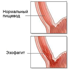 Острый эзофагит - воспалительное поражение слизистой оболочки пищевода, которое продолжается от нескольких дней до 2-3 месяцев.
