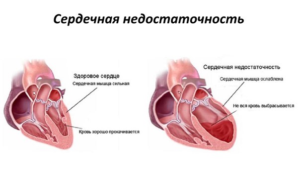 Гемодинамические и метаболические признаки сердечной недостаточности: 