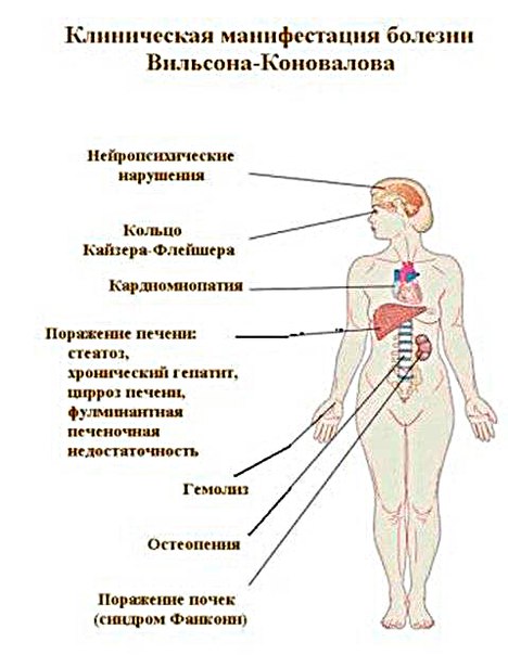 Болезнь Вильсона — Коновалова (БВК) — это наследуемая патология, ее первопричина — сбой элиминации меди из организма, что ведет к чрезмерному ее скоплению в печени, головном мозге, почках с тяжелой дисфункцией этих органов. Пик заболеваемости БВК приходится на детский, юношеский, зрелый возраст. На 25 тысяч здоровых младенцев приходится один больной БВК и один процент населения являются носителями дефектного гена, но без признаков заболевания. В отсутствие соответствующего лечения, БВК за несколько лет может закончиться смертью больного. 