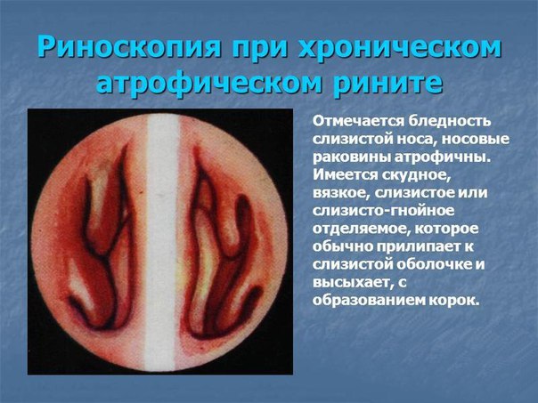 Атрофические риниты 
