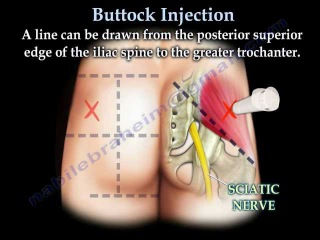 Buttock Injection - Everything You Need To Know - Dr. Nabil Ebraheim