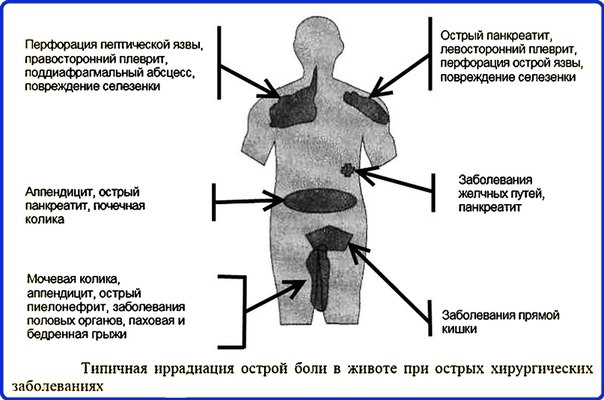 АППЕНДИКУЛЯРНЫЕ СИМПТОМЫ 