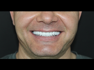 Dr- Azamat -Tekuyev - Smile-Designer - stomatologiya - BEFORE AFTER-movie and still photography