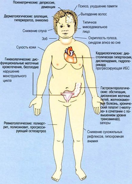Гипотиреоз - синдром, обусловленный длительным стойким недостатком гормонов щитовидной железы в организме или снижением их биологического эффекта на тканевом уровне. 