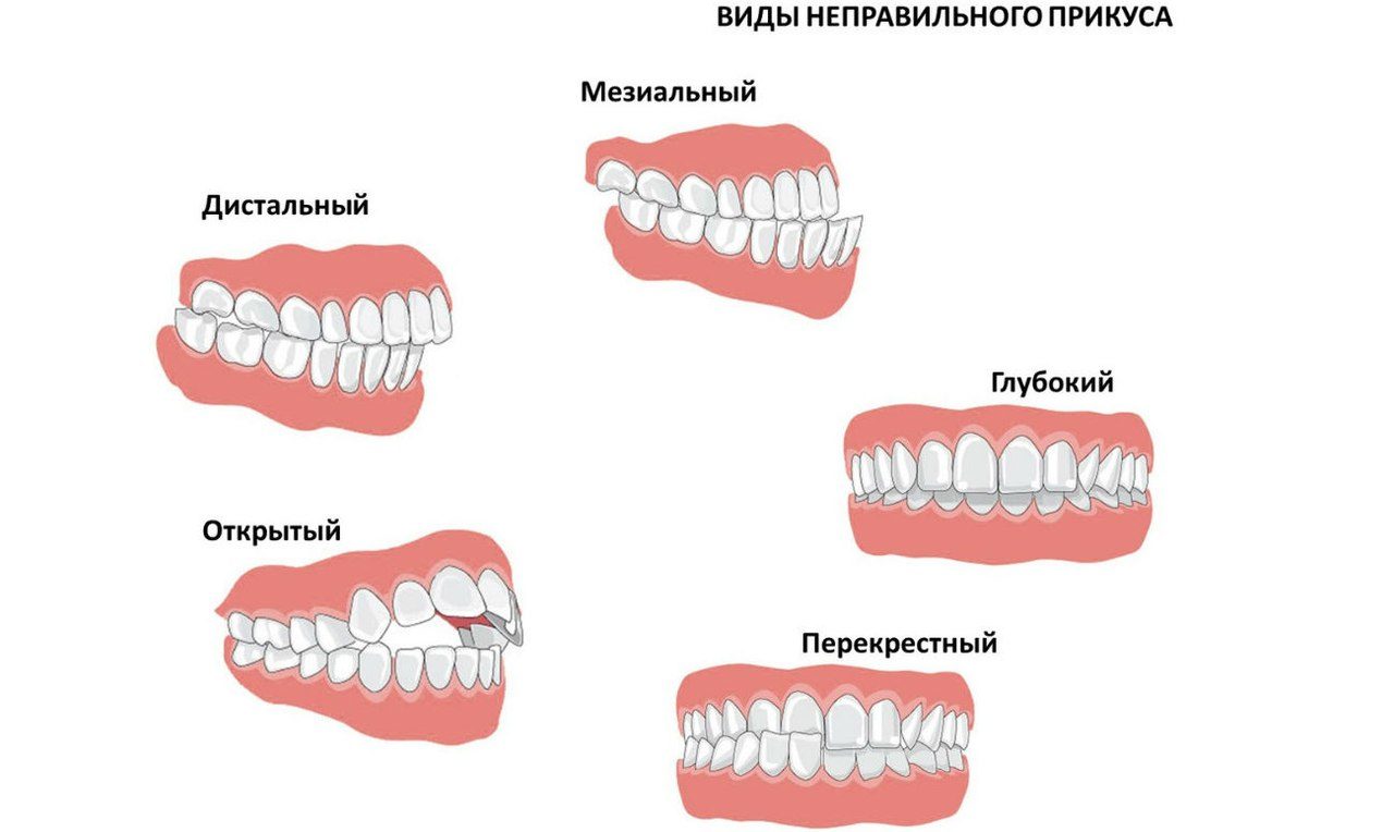 Правильная нижняя челюсть фото АНОМАЛИИ ПРИКУСА И ИХ ВЛИЯНИЕ НА ЗВУКОПРОИЗНОШЕНИЕ..Упраўленне па адукацыі Мінск