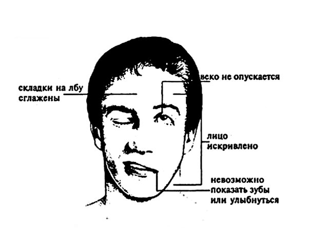Паралич 