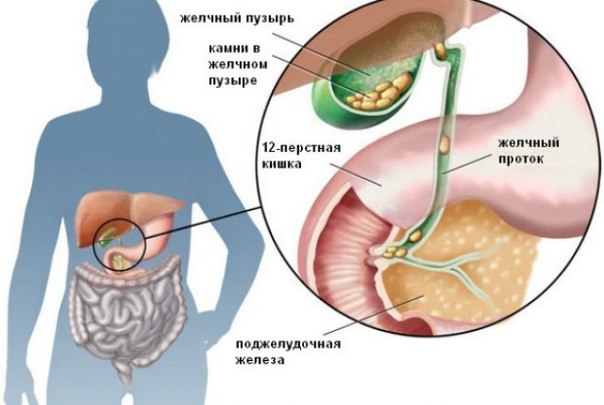 Лечение хронического холецистита