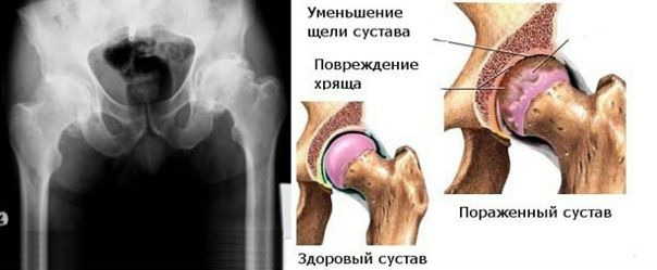 Как определить ревматоидный артрит тазобедренного сустава