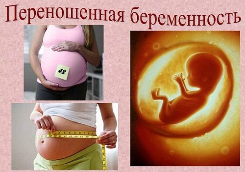 Переношенная беременность - беременность, которая продолжается более 287- 290 дней, сопровождается внутриутробным страданием плода и заканчивается рождением ребенка с признаками биологической перезрелости, что и определяет высокий риск формирования у него анте/интранатального дистресс-синдрома и затрудненной неонатальной адаптации. Впервые симптомокомплекс перезрелого плода был описан Ballantyne (1902) и Runge (1948), в связи с чем носит название синдрома Баллентайна-Рунге. Он включает отсутствие сыровидной смазки, сухость кожных покровов новорожденного, мацерацию кожи («банные» стопы, ладоши, а также в паховых и подмышечных складках), длинные ногти, плотные кости черепа, узкие швы и уменьшенные размеры родничков, зеленоватое или желтоватое окрашивание кожных покровов, плодных оболочек, пуповины. В остальных наблюдениях следует говорить о пролонгированной беременности. Это беременность, которая продолжается более 287 дней, не сопровождается страданием плода и заканчивается рождением здорового ребенка без признаков перезрелости. Таким образом, пролонгированную беременность следует рассматривать как физиологическое состояние, направленное на окончательное созревание плода. Американская ассоциация акушеров-гинекологов к переношенной относит беременность, продолжающуюся более 42 нед или 294 дней. Частота ее составляет в среднем около 10%. В большинстве европейских стран о переношенной беременности говорят, если она продолжается 294 дня и более, за исключением Португалии (287 дней и более) и Ирландии (292 дня и более). Частота переношенной беременности в Европе составляет около 3,5-5,92%. 