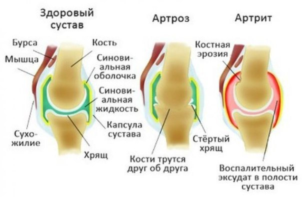 Артрит и артроз, основные симптомы и разница между ними