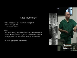 SCS Implantation - Brett R. Stacey, M.D.