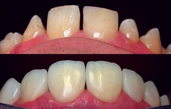 #статьи_alldental #реставрации_alldental