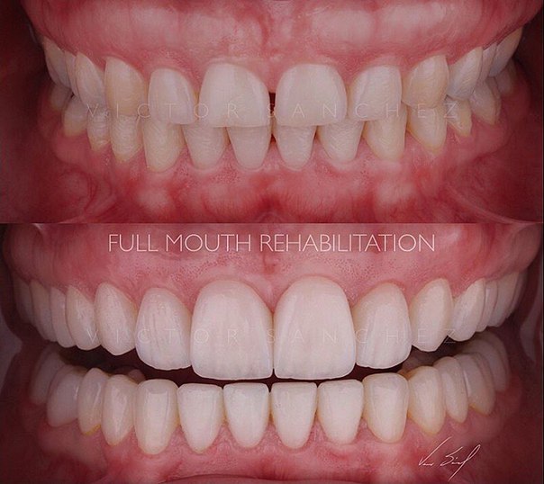 Full mouth rehabilitation