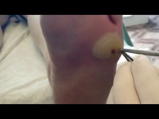 CYST OF FOOT!!!. Абсцесс стопы