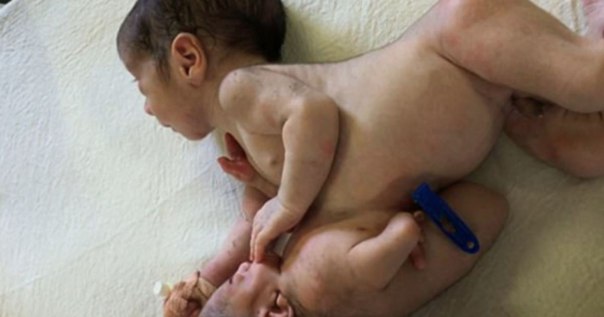 Врачи разделили сиамских близнецов, один из которых был паразитом: 