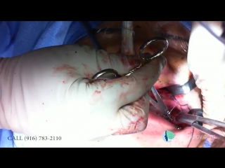Dr. Alexander Antipov. Ортогнатическая операция: LeFort- I Osteotomy, sagital split, chin reduction, cheek implants.