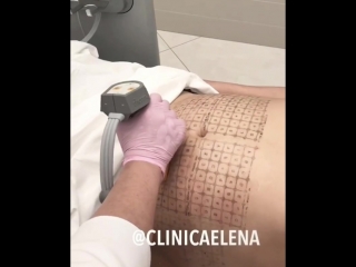 Заботимся о наших мужчинах-пациентах с помощью RF-лифтинга #Thermage 😷🙌🏻 ~~~~~~~~~~~~~~~~~~~~~ 📌Процедура проводится на аппарате