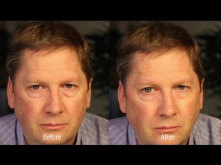 XANGO Aeris Instant Eye Gel - Amazing Before After!
