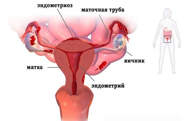 Лечение эндометриоза матки
