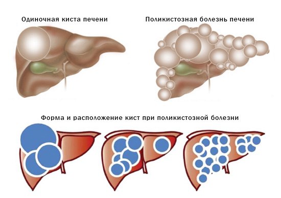 Если киста печени