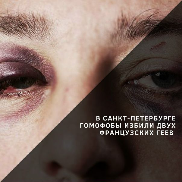 Фото: Однополая французская пара, прибывшая в Россию для того, чтобы поддержать национальную сборную на Чемпионате мира, 9 июня была атакована двумя мужчинами в Санкт-Петербурге, пишет Lenta.ru <br> <br>Это одно из первых и, вероятно, не последнее столкновение на ЧФ-2018 на почве гомофобии. Как стало известно, оба гостя из Франции получили серьезные повреждения. Нападение было совершено в тот момент, когда французы пытались поймать такси. В этот момент к ним подошли двое мужчин и, выкрикивая гомофобные лозунги, принялись избивать иностранных гостей. Иностранцы были госпитализированы. Врачи сообщили, что один из пострадавших получил серьезные повреждения челюсти, а также черепно-мозговые травмы и сотрясение мозга. <br> <br>Избитых иностранцев злоумышленники бросили лежать посреди улицы и сбежали. <br>Полиция оперативно задержала нападавших. Ими оказались 25-летний Исмет Гайдаров и 24-летний Даугав Расул Магомедов. <br> <br>Отметим, что это не единичный случай нападения на иностранцев в дни чемпионата мира по футболу, который стартовал в России: избили еще одного гостя из Франции, на которого напал и избил его возмущенный оплатой таксист. <br> <br>Ранее в FIFA неоднократно говорили о том, что будут проявлять нулевую терпимостью к дискриминации по признаку сексуальной ориентации/гендерной идентичности на ЧМ 2018. Однако, пока никаких заявлений по этому поводу сделано не было. <br> <br>Напоминаем вам, что на время проведения чемпионата ЛГБТ-группа 