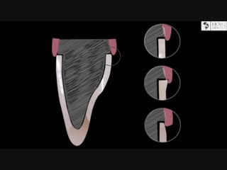 Как выполнить ретракцию / How to Dentist