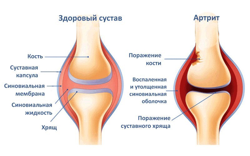 ортопедические стельки для снижения нагрузки на коленный сустав