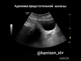 НЕУМЫВАКИН АДЕНОМА ПРЕДСТАТЕЛЬНОЙ ЖЕЛЕЗЫ СКАЧАТЬ БЕСПЛАТНО НЕУМЫВАКИН АДЕНОМА ПРЕДСТАТЕЛЬНОЙ ЖЕЛЕЗЫ СКАЧАТЬ БЕСПЛАТНО