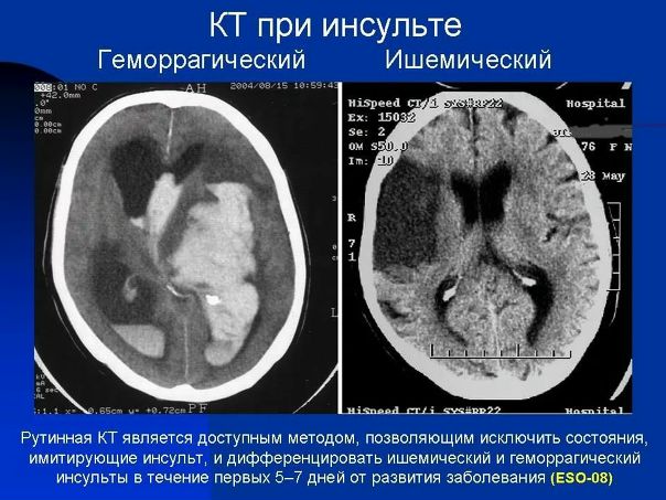 Геморрагический инсульт — спонтанное (нетравматическое) кровоизлияние в полость черепа. Термин «геморрагический инсульт» используют, как правило, для обозначения внутримозгового кровоизлияния, произошедшего в результате какого-либо сосудистого заболевания головного мозга: атеросклероза, гипертонической болезни и амилоидной ангиопатии. Наиболее часто геморрагический инсульт возникает на фоне повышенного артериального давления. Клиническая картина характеризуется острым началом и быстрым развитием симптомов, которые напрямую зависят от локализации сосудистой катастрофы. Геморрагический инсульт требует неотложной гемостатической, антигипертензионной и противоотечной терапии. По показаниям проводится хирургическое лечение. 