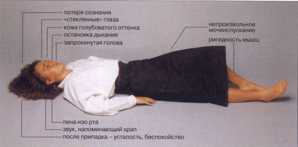 Эпилепсия — состояние, характеризующееся повторными (более двух) эпилептическими приступами, не спровоцированными какими-либо немедленно определяемыми причинами. Эпилептический приступ — клиническое проявление аномального и избыточного разряда нейронов мозга, вызывающего внезапные транзиторные патологические феномены (чувствительные, двигательные, психические, вегетативные симптомы, изменения сознания). Следует помнить, что несколько спровоцированных или обусловленных какими-либо отчетливыми причинами (опухоль мозга, ЧМТ) эпилептических приступов не свидетельствуют о наличии у пациента эпилепсии. Эпилепсия — состояние, характеризующееся повторными (более двух) эпилептическими приступами, не спровоцированными какими-либо немедленно определяемыми причинами. Эпилептический приступ — клиническое проявление аномального и избыточного разряда нейронов мозга, вызывающего внезапные транзиторные патологические феномены (чувствительные, двигательные, психические, вегетативные симптомы, изменения сознания). Следует помнить, что несколько спровоцированных или обусловленных какими-либо отчетливыми причинами (опухоль мозга, ЧМТ) эпилептических приступов не свидетельствуют о наличии у пациента эпилепсии.