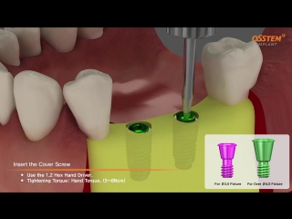OSSTEM implant - Ортопедический протокол.Имплантация.