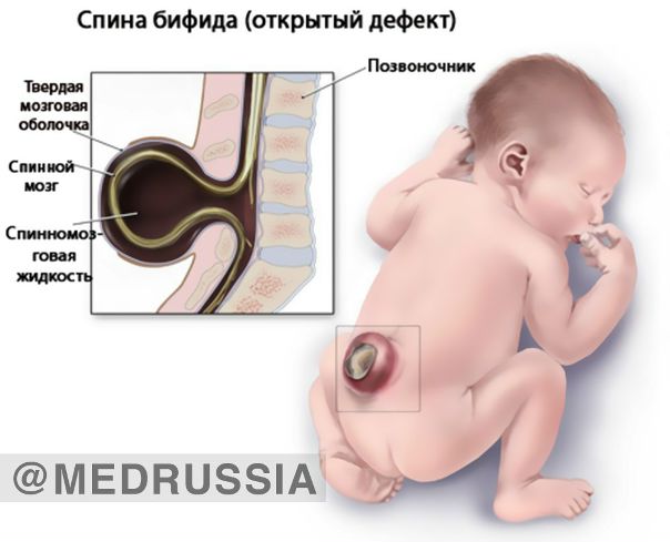 Расщепление позвоночника, незаращение дужки позвонка (лат. Spina bifida, англ. split spine) — порок развития позвоночника, часто сочетающийся с дефектами развития спинного мозга. Порок представляет собой неполное закрытие нервной трубки в неполностью сформированном спинном мозге. 
