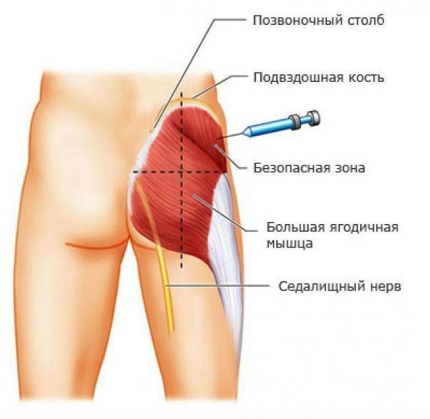 ПОД КАКИМ УГЛОМ ДЕЛАТЬ ИНЪЕКЦИИ 