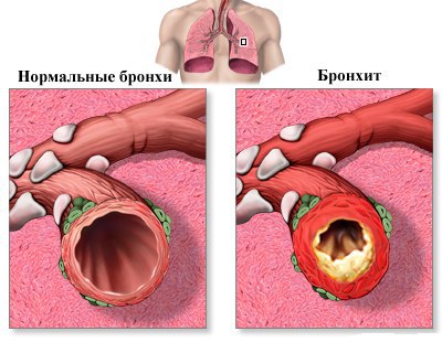 Бронхит