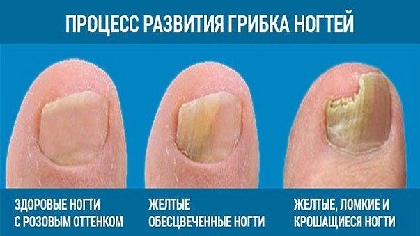 ЭФФЕКТИВНЫЕ СРЕДСТВА ДЛЯ ЛЕЧЕНИЯ ГРИБКА НОГТЕЙ 