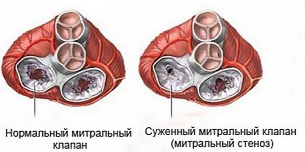 Митральный стеноз 