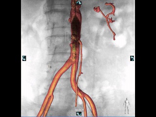 Philips Healthcare - Imagens - 3D RoadMap com Micro-Cateter - G