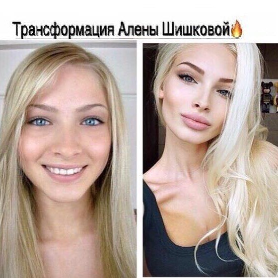 А это Алена Шишкова до и после пластики!