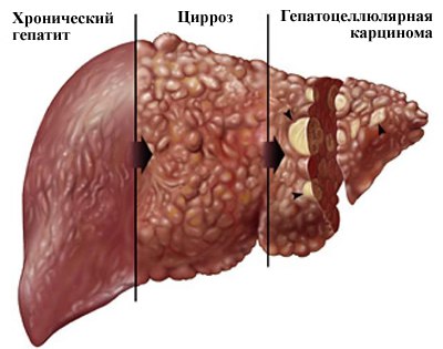 Хронический гепатит - это диффузное воспалительно-дистрофическое заболевание печени, возникающее по различным причинам, оно длится свыше 6 месяцев. Хронический гепатит - это диффузное воспалительно-дистрофическое заболевание печени, возникающее по различным причинам, оно длится свыше 6 месяцев.