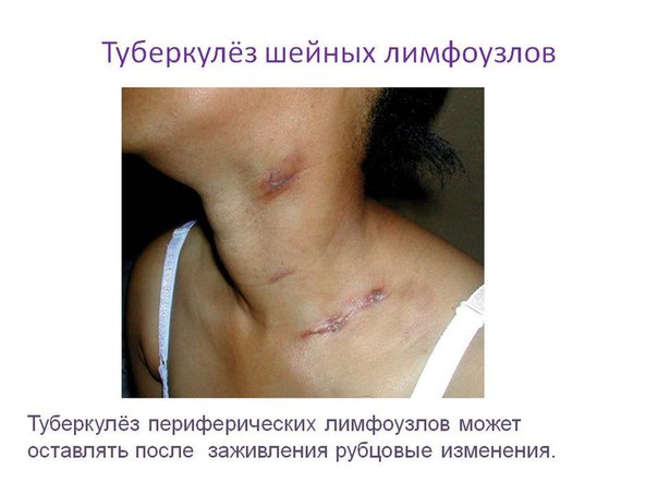 Туберкулез лимфатических узлов