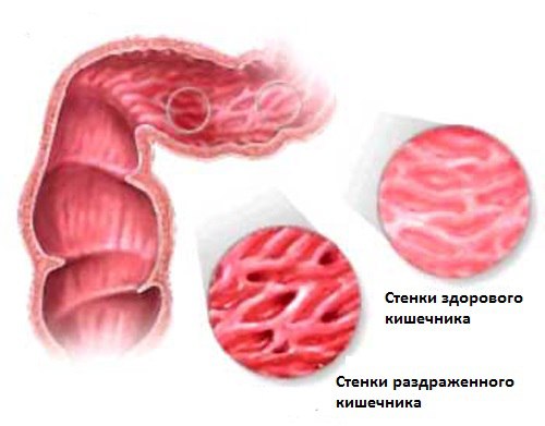 Синдром раздражённой кишки - функциональное расстройство ЖКТ, проявляющееся сочетанием нарушений акта дефекации с болевым синдромом при отсутствии органических изменений кишки.